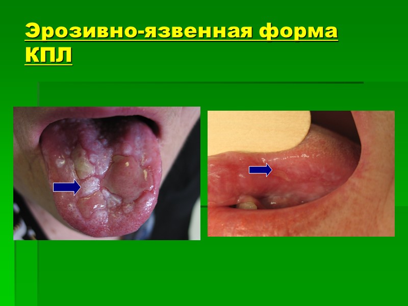Эрозивно-язвенная форма КПЛ